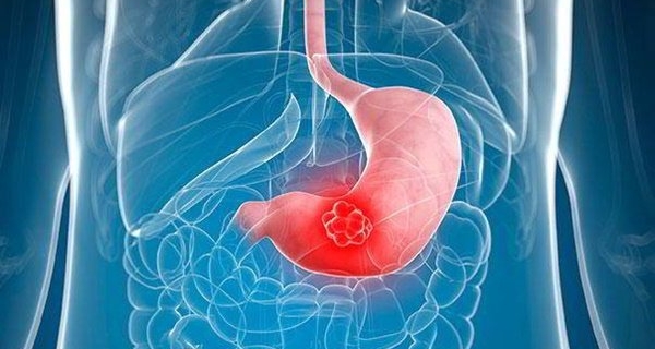 DẤU HIÊU CỦA BỆNH ĐAU DẠ DÀY