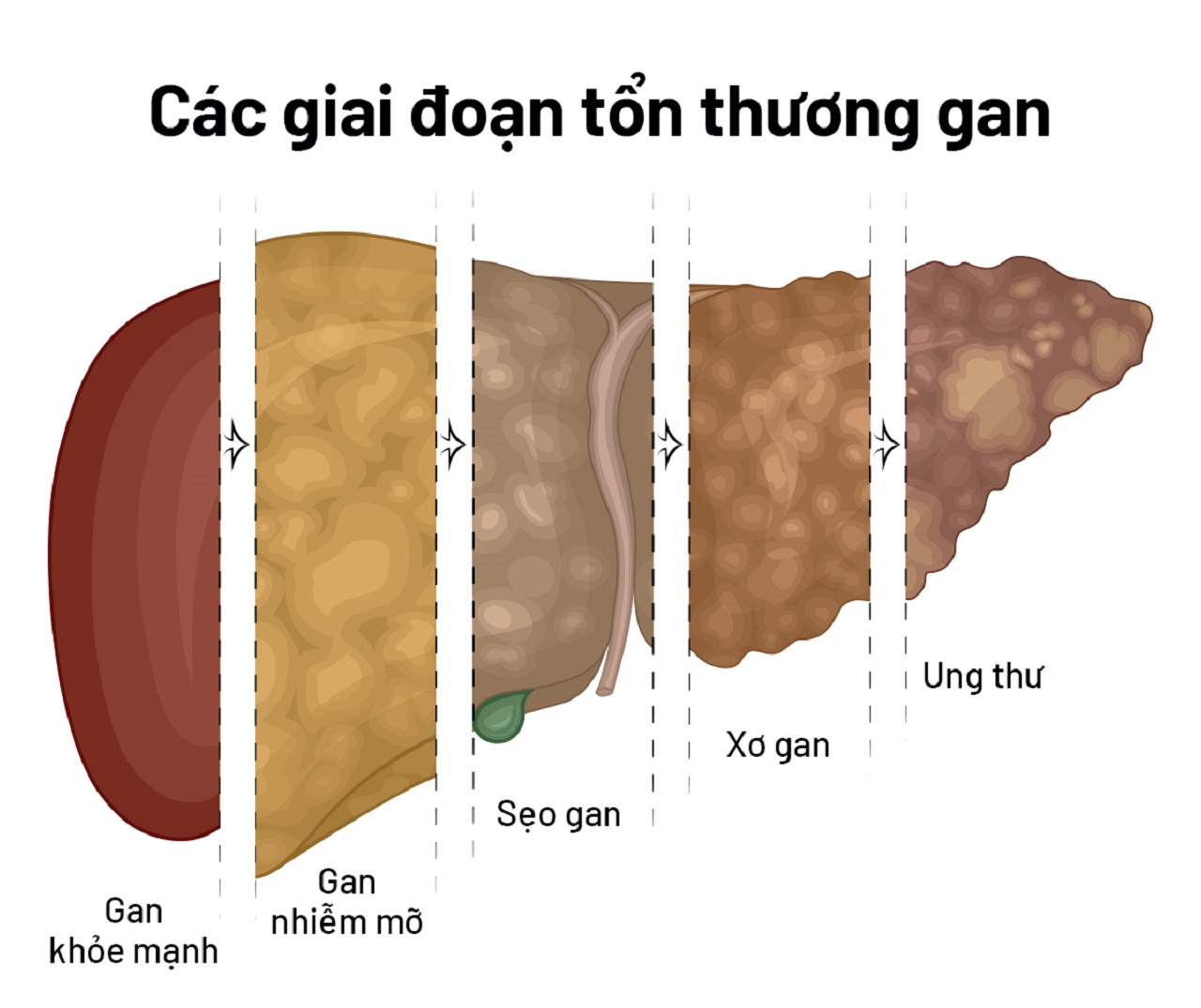 Minh họa các giai đoạn tổn thương gan