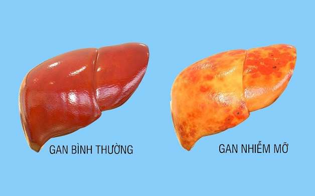 Gan nhiễm mỡ là gì?